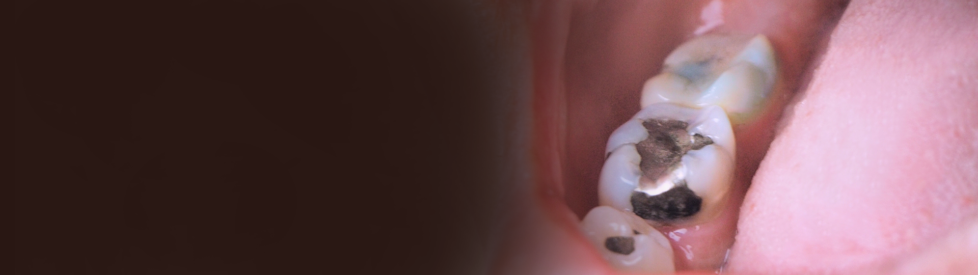 Composite Filling Banner image – Chatfield Dental Centre