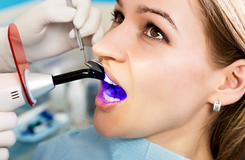 Composite Fillings cost in London - Chatfield Dental Centre Battersea