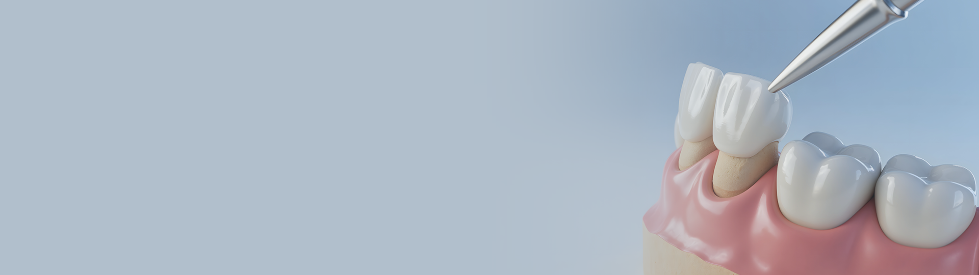 Dental Crown banner image – Chatfield Dental Centre
