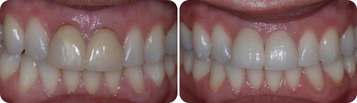 Dental Crown Case Studies image 2