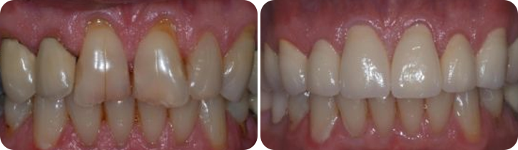 Dental Crown Case Studies image 3