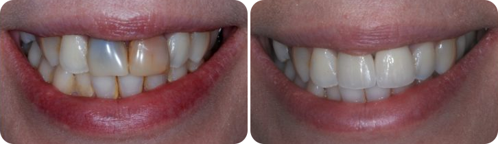 Dental Crown Case Studies image