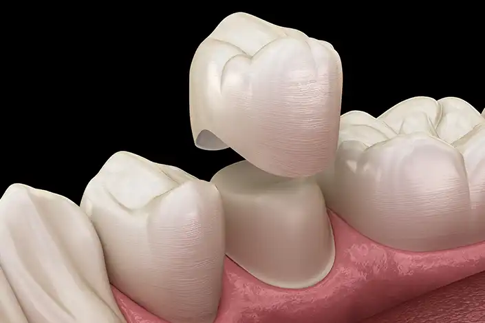 Dental Crown treatment in Battersea – Chatfield Dental Centre