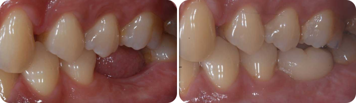 Dental Implant case studies image 3