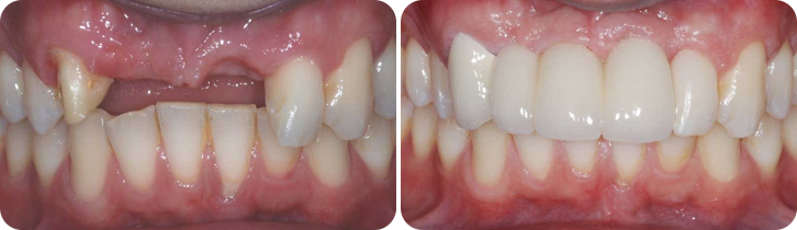 Dental Implant case studies image 4
