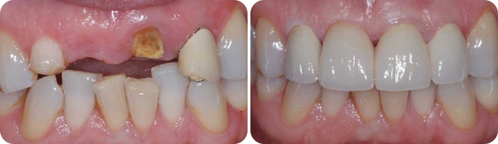 Dental Implant case studies image