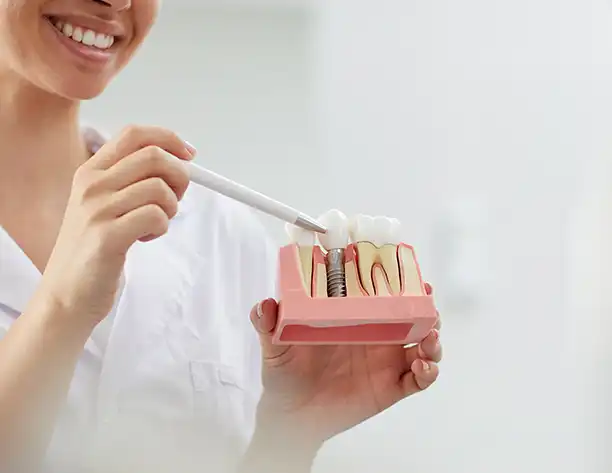Dental Implant in Battersea