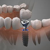 Dental Implants treatment in Battersea