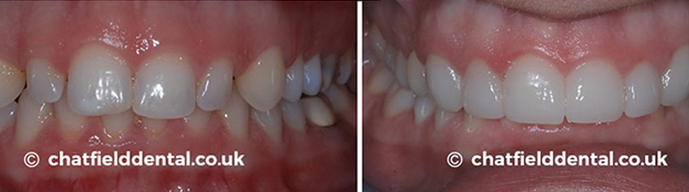 Porcelain Veneers before after image 6