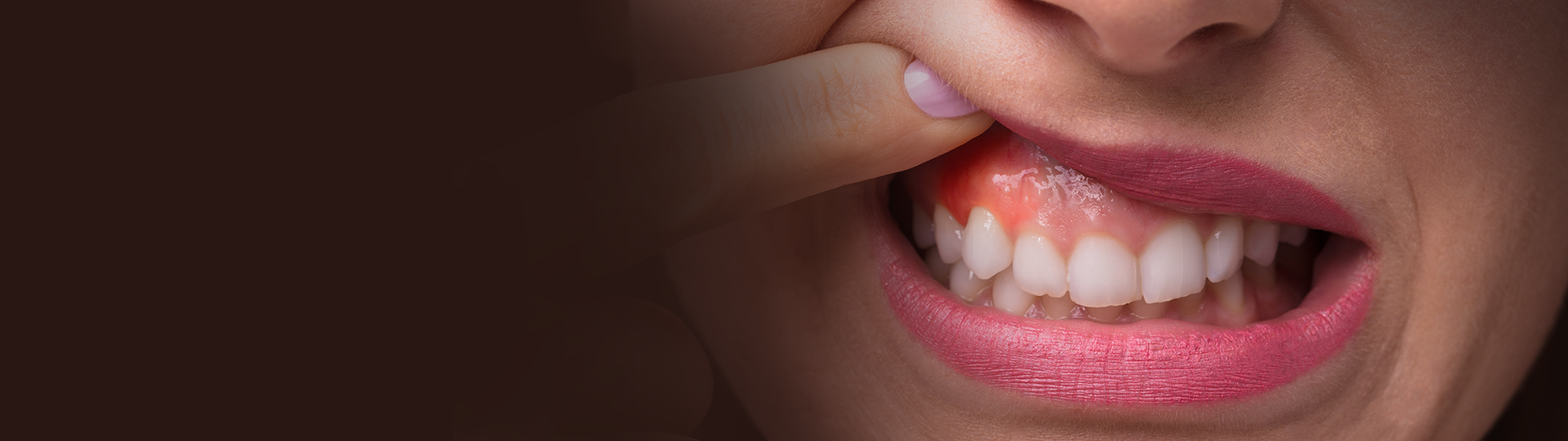 Gum Disease Banner image – Chatfield Dental Centre