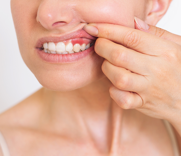 Gum Disease Treatment in Battersea