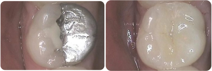 Porcelain Inlays Case Studies image 2