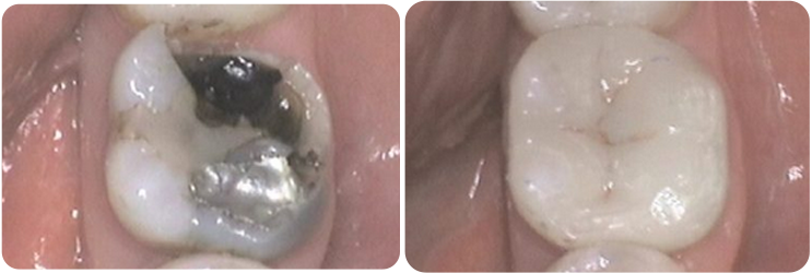 Porcelain Inlays Case Studies image 3