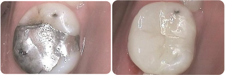 Porcelain Inlays Case Studies image