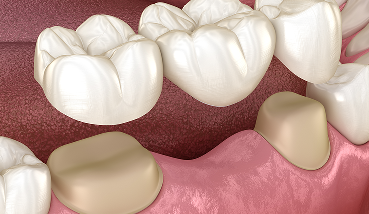 Porcelain inlays in Battersea – Chatfield Dental Centre