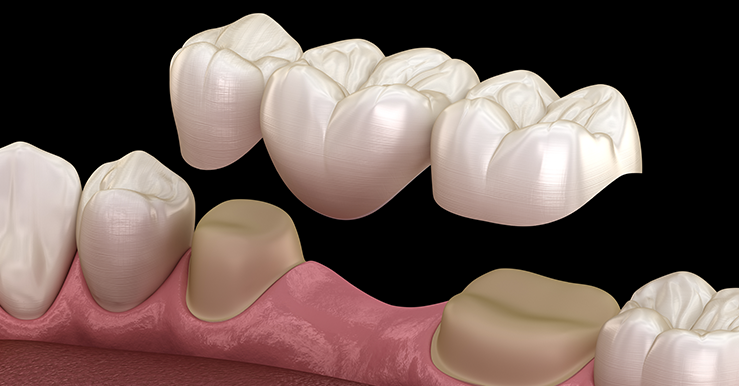 Porcelain inlays treatment cost