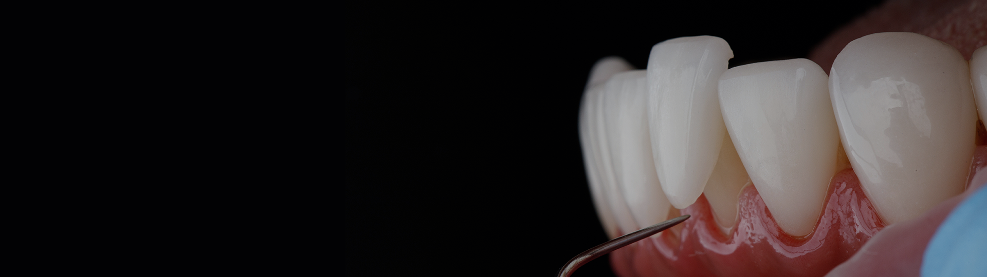 Porcelain Veneers Banner image – Chatfield Dental Centre