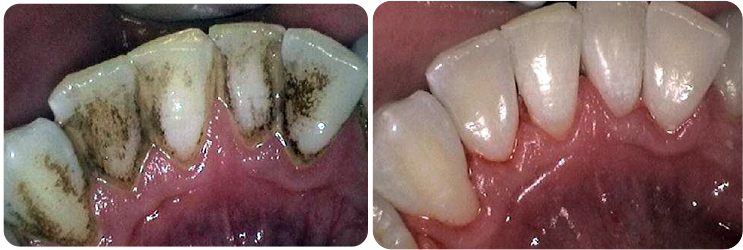 Prophyflex Stain Removal Case Studies 1