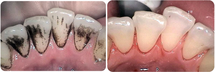 Prophyflex Stain Removal Case Studies 2