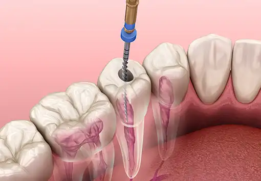 Root Canal Dentist in Battersea, London