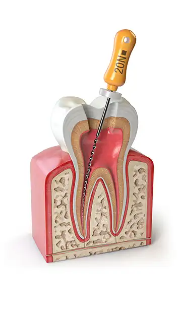 Root Canal Treatment in Battersea – Chatfield Dental Centre