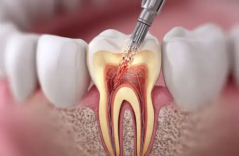 Root Canal Treatment Battersea, London