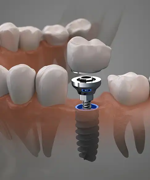 Teeth Implants in Battersea, London