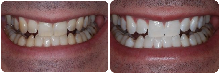 Teeth Whitening Case Studies image 2