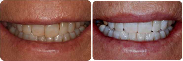 Teeth Whitening Case Studies image 3