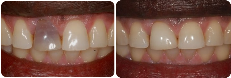 Teeth Whitening Case Studies image