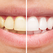 Teeth Whitening treatment in Battersea by Chatfield Dental Centre