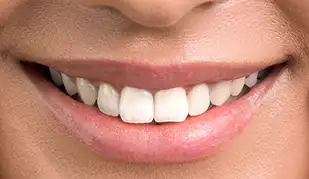 Teeth Whitening treatment at Battersea - Chatfield Dental Centre