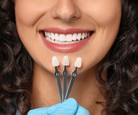Veneers in Battersea, London