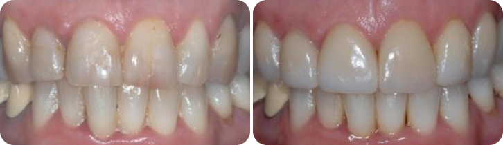 Veneers Case Studies image 2