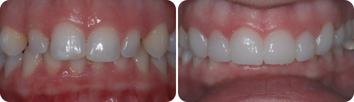 Veneers Case Studies image 4