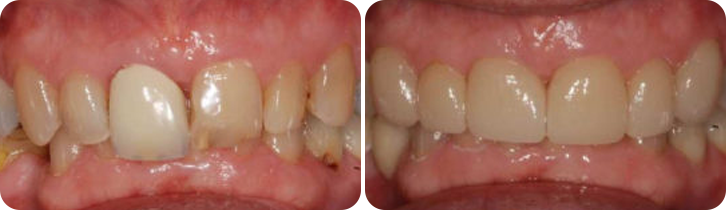 Veneers Case Studies image 5