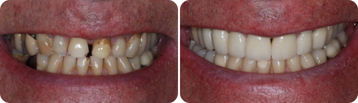 Veneers Case Studies image