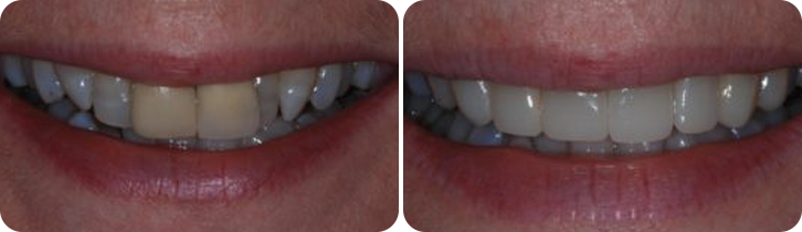 Veneers Case Studies image 3