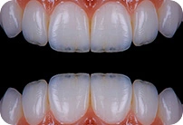 Chatfield Dental Centre Composite Bonding thumbnail