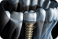 Chatfield Dental Centre Dental Implants thumbnail