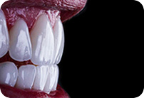 Chatfield Dental Centre Veneers thumbnail