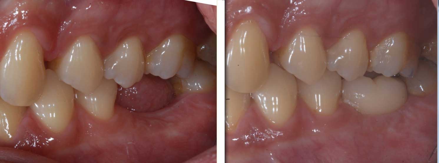 chatfield dental implant