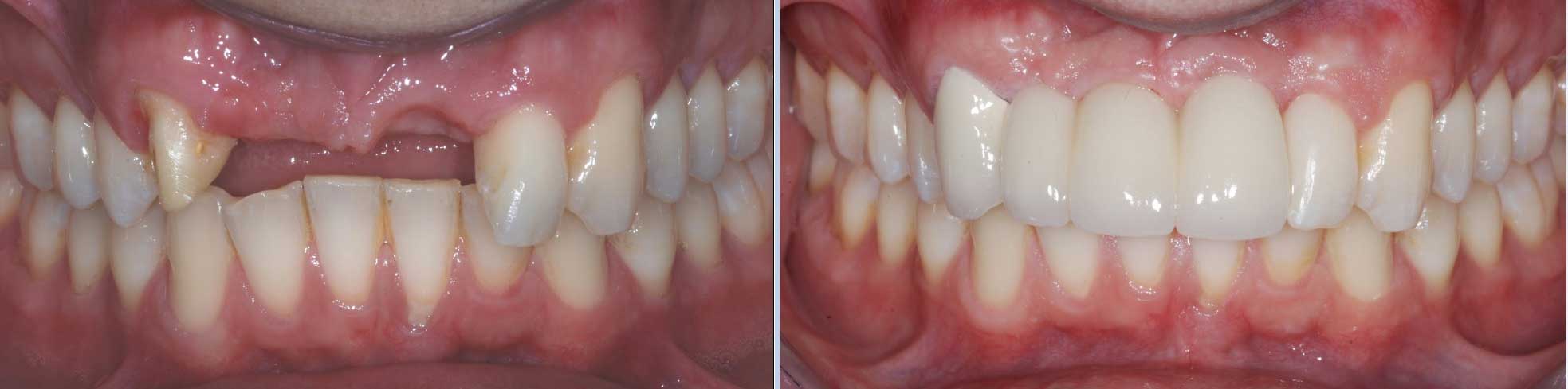 tooth implant battersea