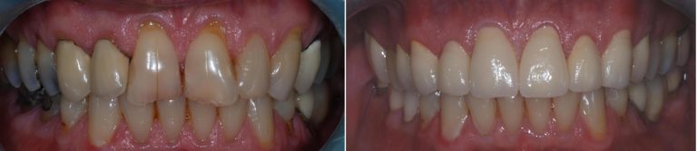 dental crown treatment battersea