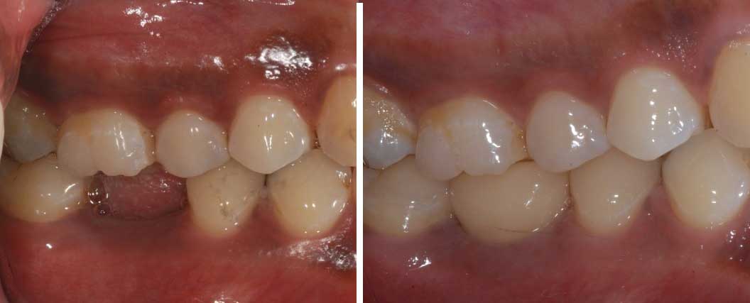 Chatfield dental tooth implant image 1