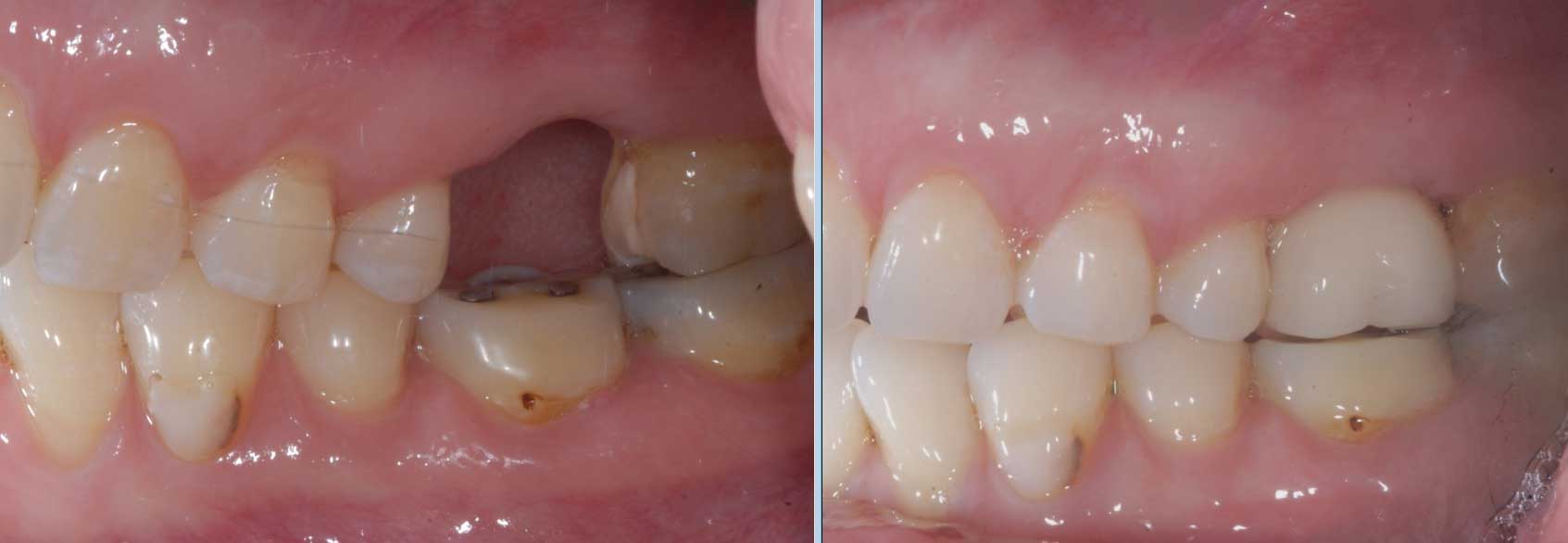 Chatfield dental tooth implant image 3