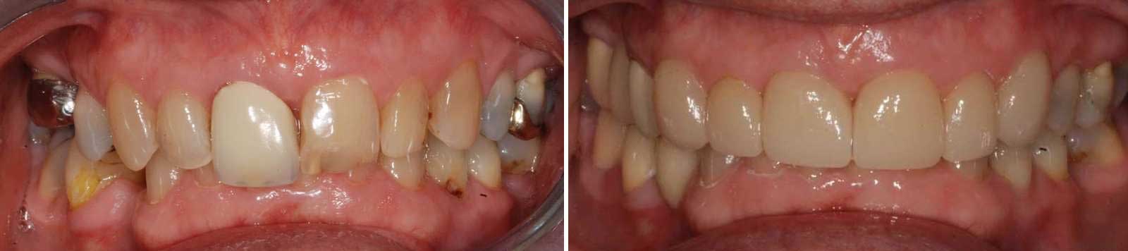 dental implant battersea