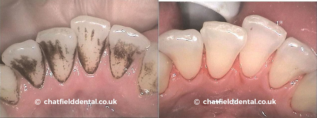 Hygienist Stain Removal 2