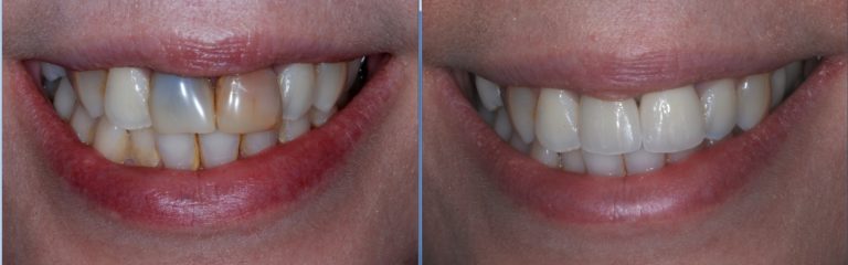 dental crown - Case Studies