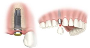 Dental Implants Battersea